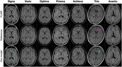 Scanner agnostic large-scale evaluation of MS lesion delineation tool for clinical MRI